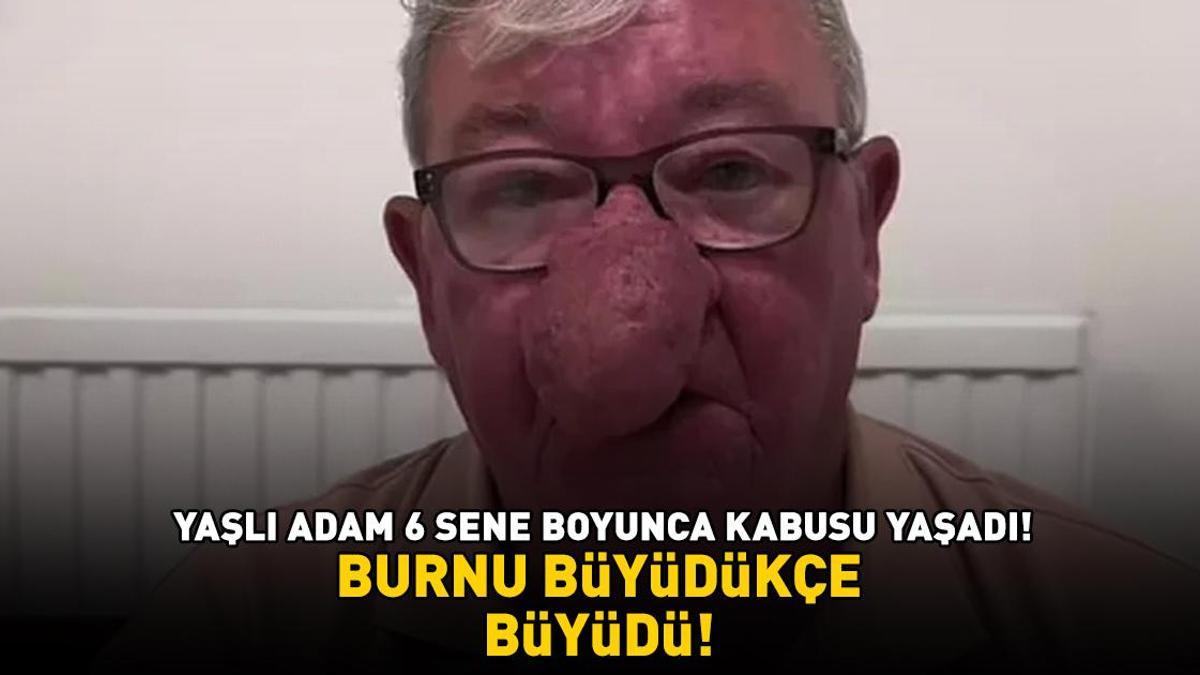 Burnu büyüdükçe büyüdü! 68 yaşındaki adam kabusu yaşadı! 4 saatlik operasyonla adeta yeniden doğdu Detaylar…